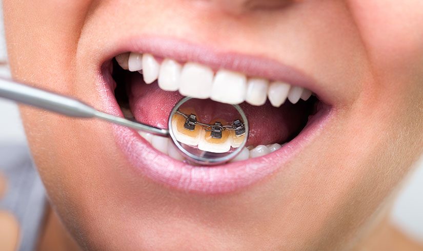 Ortodoncia lingual - Brackets linguales