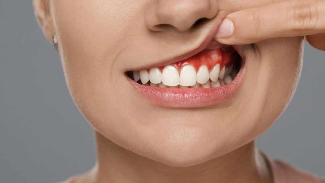 Absceso dental: causas, síntomas y tratamiento - Clínica Dental Ramis Tauler absceso dental