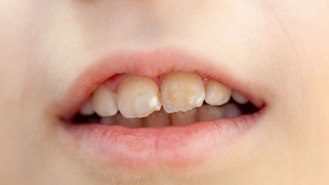 fluorosis dental