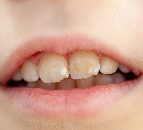 fluorosis dental